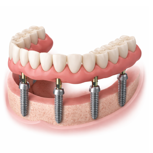 All-on-4 dental implant technique. Four titanium posts supporting a permanent bridge in the jaw.