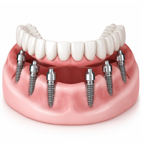 All-on-6 dental implant bridge showing six titanium posts for maximum jaw stability and full-arch restoration in Oman.