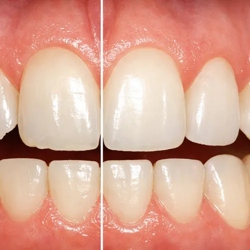 Closing a small gap between front teeth using tooth-colored composite bonding in a single visit at Al Rabeeh.