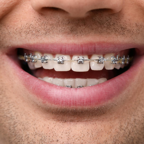 Discreet Damon braces on an adult patient, providing nearly invisible orthodontic treatment in Musca