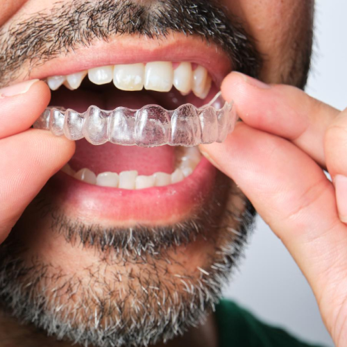 Clear Invisalign aligner made from SmartTrack material for discreet and comfortable teeth straightening in Oman.