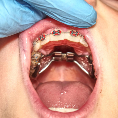 Detailed view of custom lingual braces bonded to the inner surface of teeth for invisible orthodontic treatment.