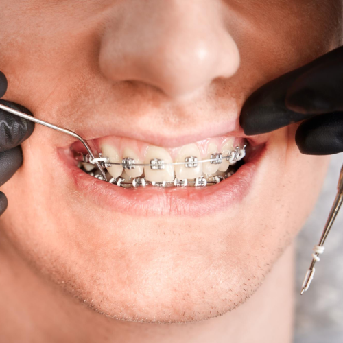 Durable stainless steel metal braces on a young patient in Muscat, offering reliable and fast tooth alignment.