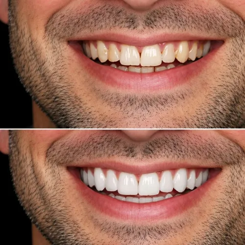 Porcelain Veneers in Al Rabeeh - Maabilah