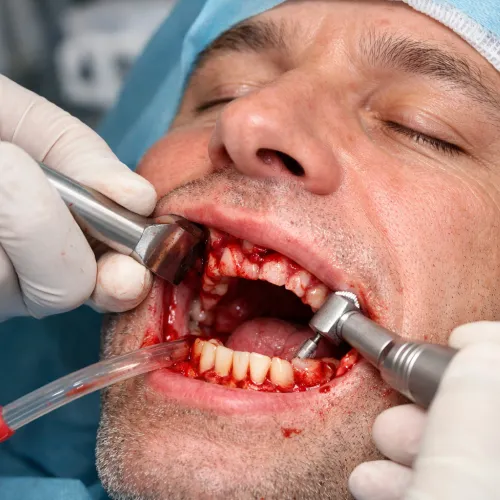 Pre-prosthetic Surgery