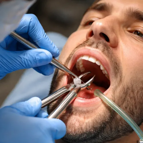 Routine Extractions at Al Rabeeh Dental Clinic muscat, Oman