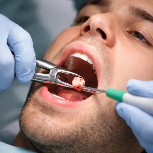 Wisdom Teeth removal