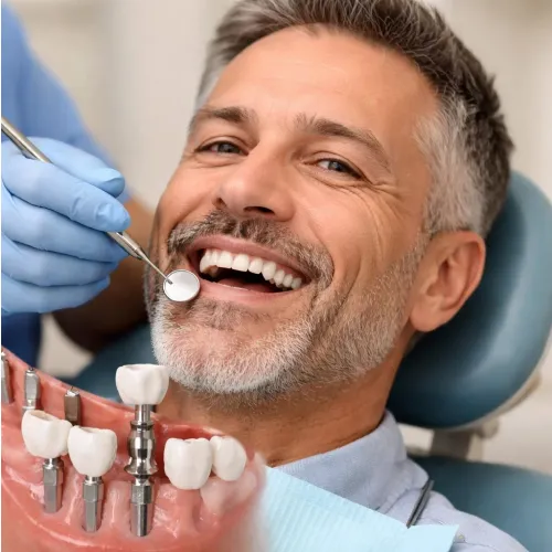 Implants for Missing Teeth