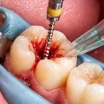 5 Signs You Need a Tooth Canal (Before it Hurts)