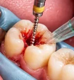 root canal treatment