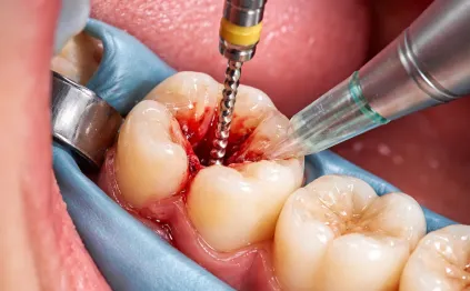 root canal treatment